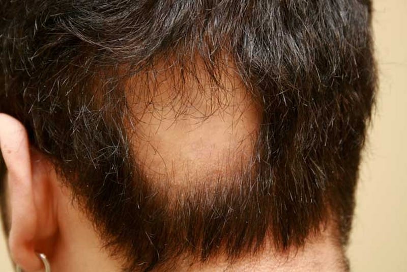Alopecia Areata