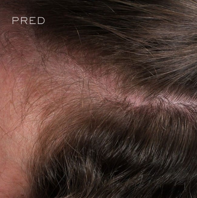 Alopecia areata, Hair Loss