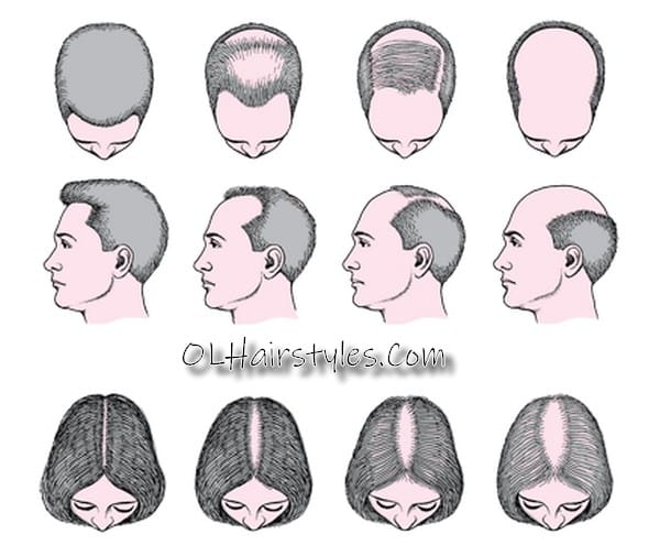 androgenic alopecia hair loss